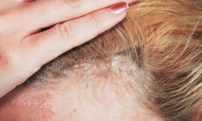 hair psoriasis